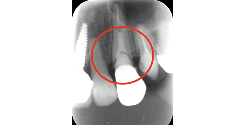 断髄治療・MTM症例3