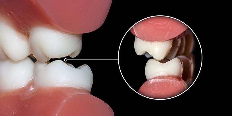写真でわかるボトックス治療