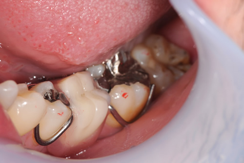 歯を失った時の治療選択肢（入れ歯）