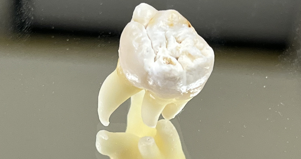 抜去歯の写真3