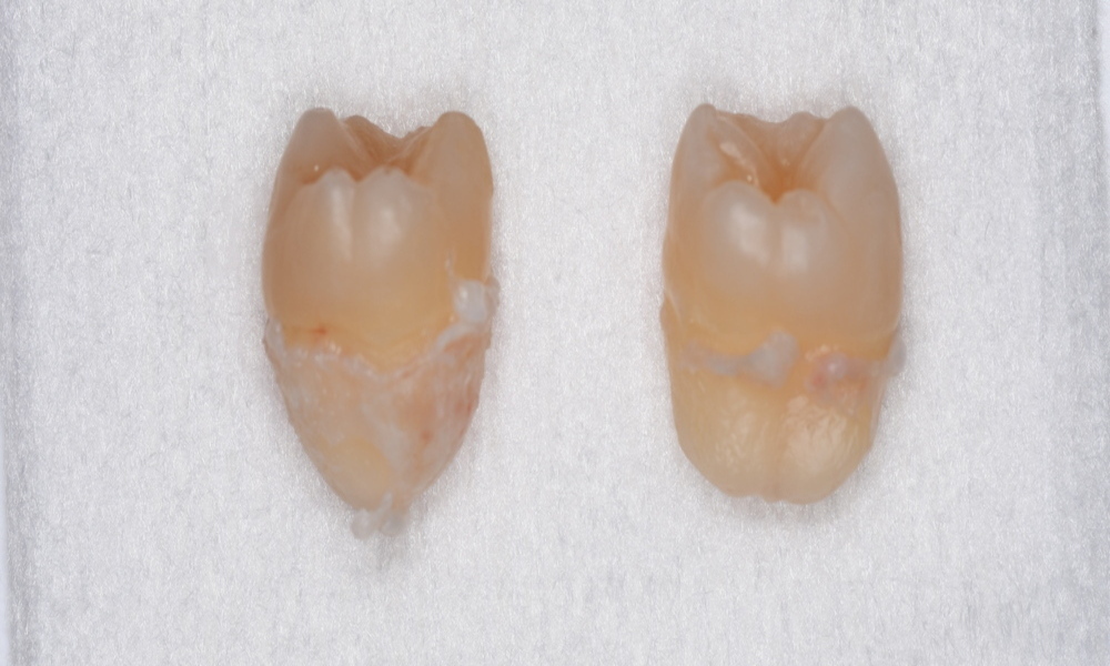 抜去歯の写真4