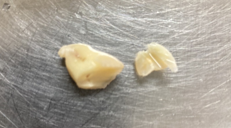 抜去歯の写真8