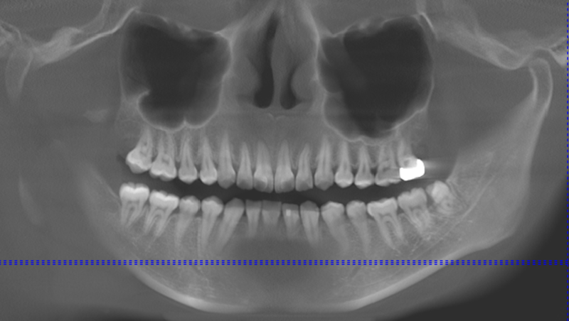 抜去歯の写真7