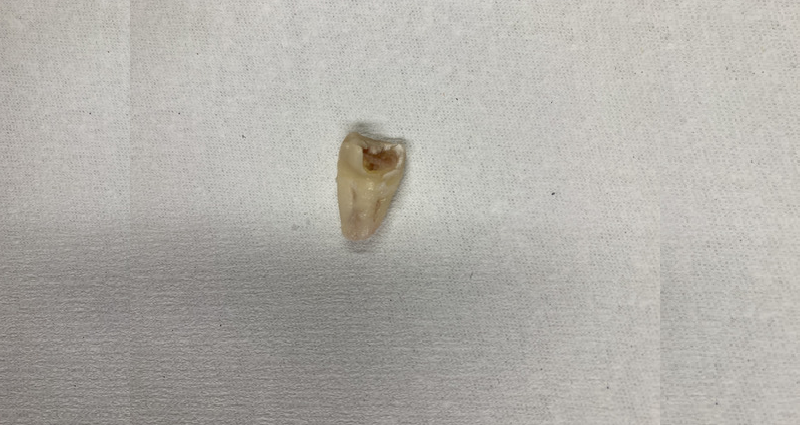 抜去歯の写真10