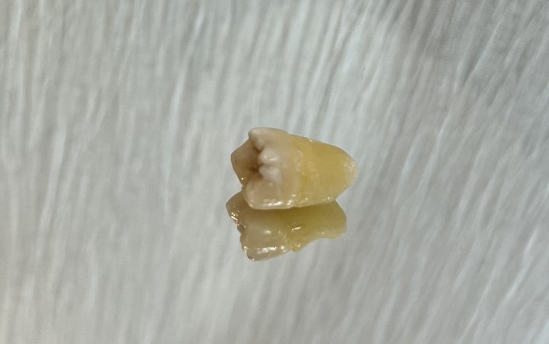 抜去歯の写真13