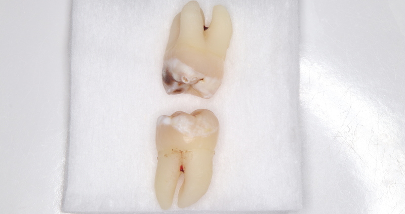 抜去歯の写真19
