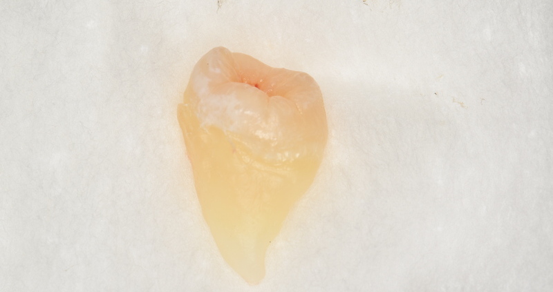抜去歯の写真21
